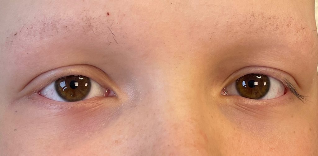 Dit is een beeld van ogen van een jongen voor behandeling wenkbrauwen permanente make-up Alopecia Behandeling